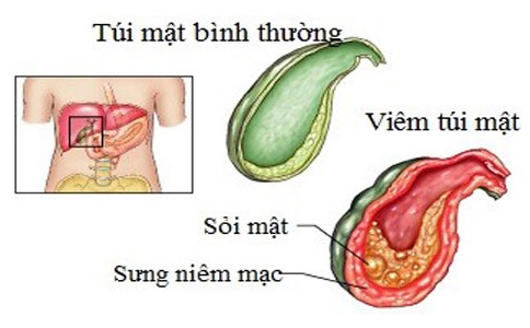 Cholangitis - Ảnh minh họa 4