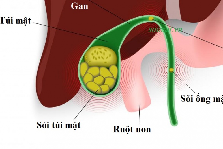 Cholangitis - Ảnh minh họa 3