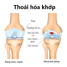 Degenerative Joint Disease - Ảnh minh họa 1