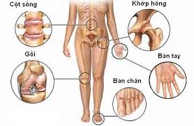 Degenerative Joint Disease - Ảnh minh họa 2