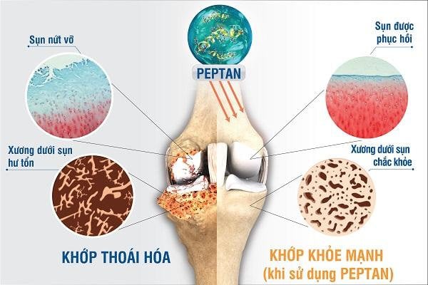 Degenerative Joint Disease - Ảnh minh họa 3