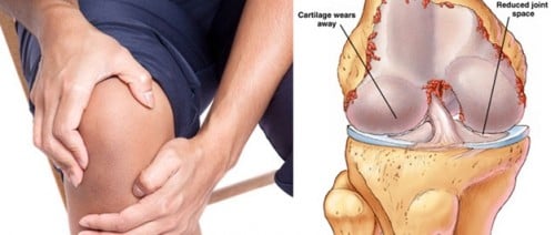 Degenerative Joint Disease - Ảnh minh họa 5