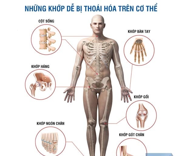 Degenerative Joint Disease - Ảnh minh họa 4