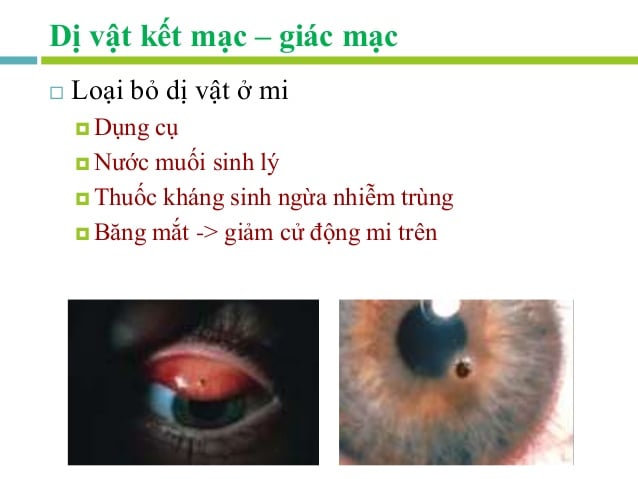 Dị vật trong giác mạc - Ảnh minh họa 3