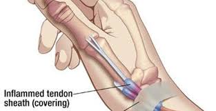 De Quervain syndrome - Ảnh minh họa 2