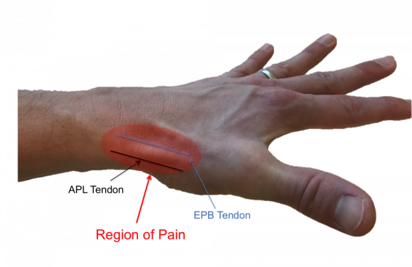 De Quervain syndrome - Ảnh minh họa 3