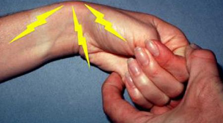 De Quervain syndrome - Ảnh minh họa 4