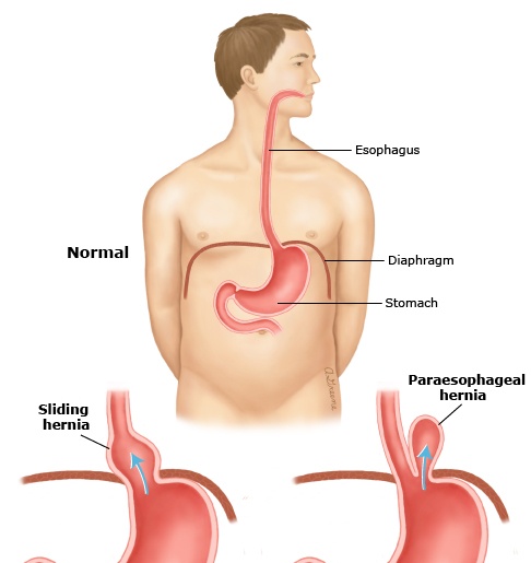 Diaphragmatic hernia - Ảnh minh họa 1