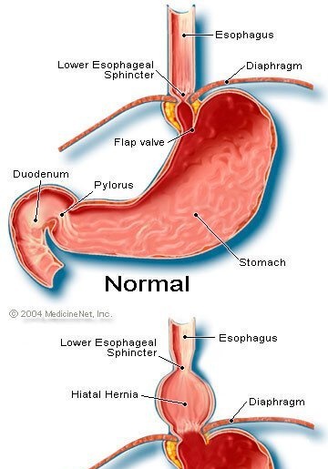 Diaphragmatic hernia - Ảnh minh họa 2