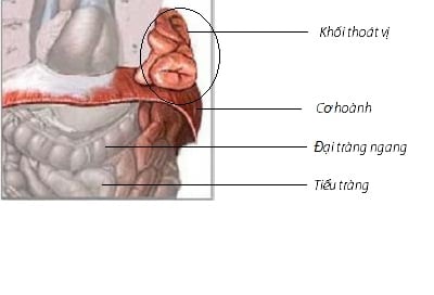 Diaphragmatic hernia - Ảnh minh họa 3