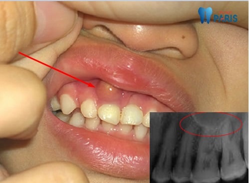 Dentigerous cyst - Ảnh minh họa 3