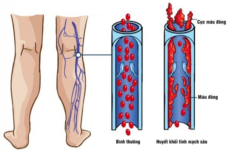 DVT - Ảnh minh họa 1