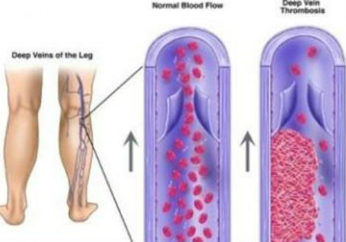 DVT - Ảnh minh họa 3