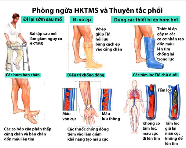 DVT - Ảnh minh họa 4