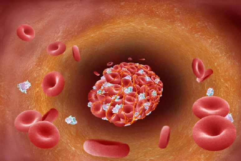 Diseminated Intravascular Coagulation - Ảnh minh họa 2