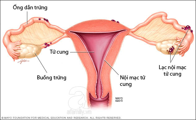 Bất túc cổ tử cung - Ảnh minh họa 1