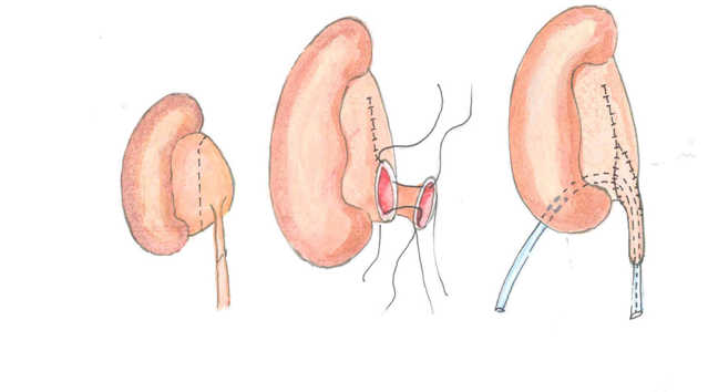 Dị tật đường tiết niệu - Ảnh minh họa 3