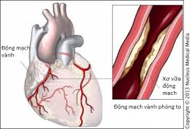 Dị tật động mạch vành - Ảnh minh họa 1