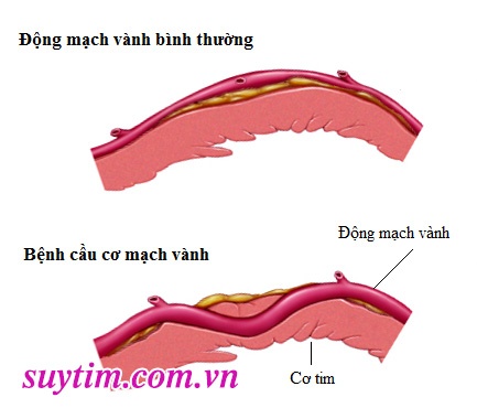 Dị tật động mạch vành - Ảnh minh họa 2