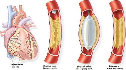 Dị tật động mạch vành - Ảnh minh họa 3