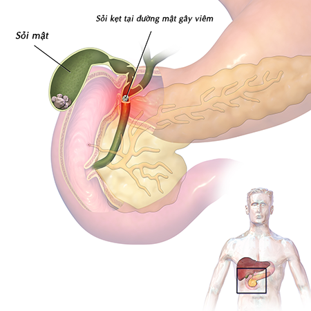 Dyspepsia - Ảnh minh họa 3