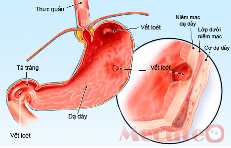 Duodenal Cancer - Ảnh minh họa 2