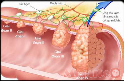 Duodenal Cancer - Ảnh minh họa 4