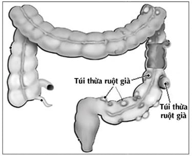 Diverticulitis - Ảnh minh họa 1