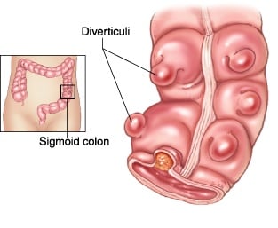 Diverticulitis - Ảnh minh họa 2