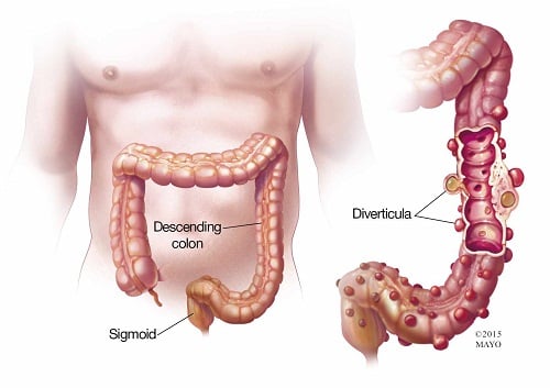 Diverticulitis - Ảnh minh họa 3