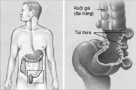 Diverticulitis - Ảnh minh họa 4