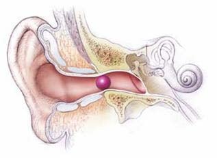 Dị vật trong tai - Ảnh minh họa 1