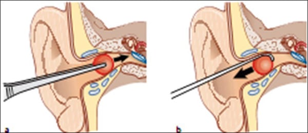 Dị vật trong tai - Ảnh minh họa 3