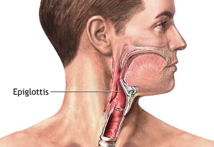 Epiglottitis - Ảnh minh họa 2