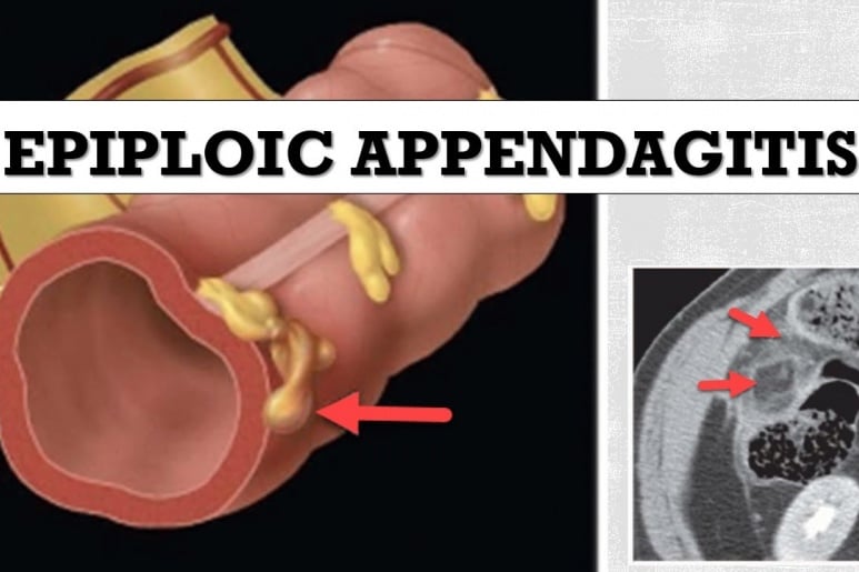 Epiploic Appendagitis - Ảnh minh họa 2