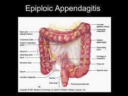 Epiploic Appendagitis - Ảnh minh họa 4