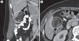 Epiploic Appendagitis - Ảnh minh họa 3