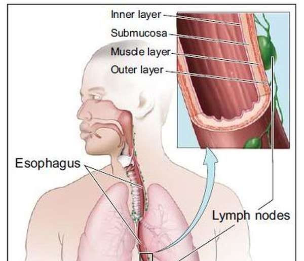 Esophageal Atresia - Ảnh minh họa 1