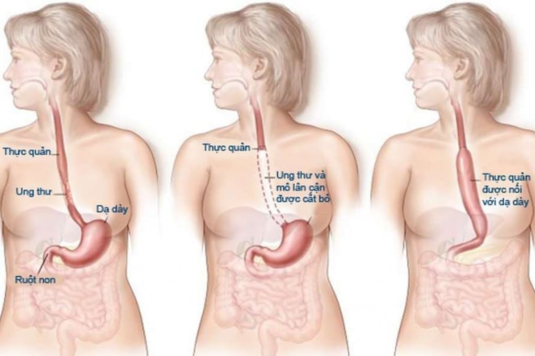 Esophageal Atresia - Ảnh minh họa 2