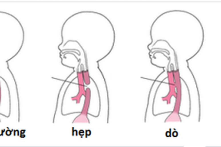 Esophageal Atresia - Ảnh minh họa 3