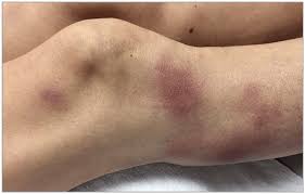 Erythema Nodosum - Ảnh minh họa 1