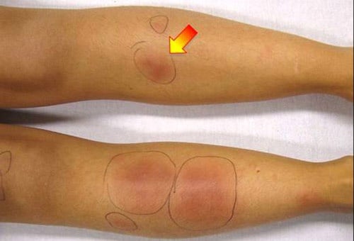 Erythema Nodosum - Ảnh minh họa 2