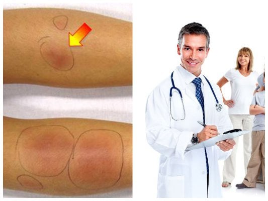 Erythema Nodosum - Ảnh minh họa 4