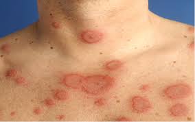 Erythema multiforme - Ảnh minh họa 2