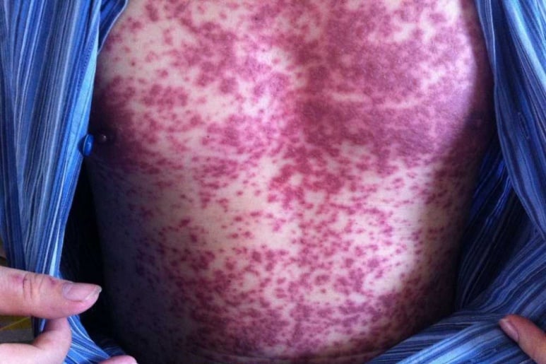 Erythema multiforme - Ảnh minh họa 3