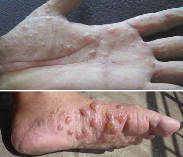 Eczema - Ảnh minh họa 2