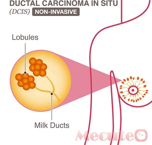 Ductal Carcinoma In Situ - Ảnh minh họa 2