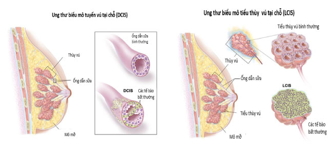 Ductal Carcinoma In Situ - Ảnh minh họa 4