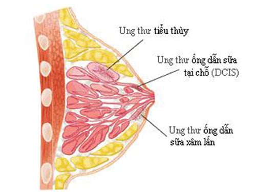 Ductal Carcinoma In Situ - Ảnh minh họa 3