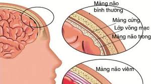 Encephalitis - Ảnh minh họa 3